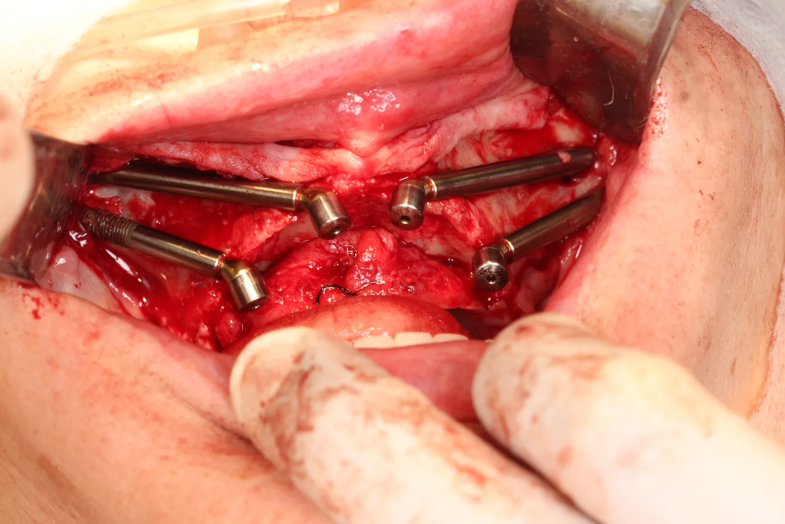 Foto cirúrgica: quatro implantes zigomáticos instalados, dois de cada lado