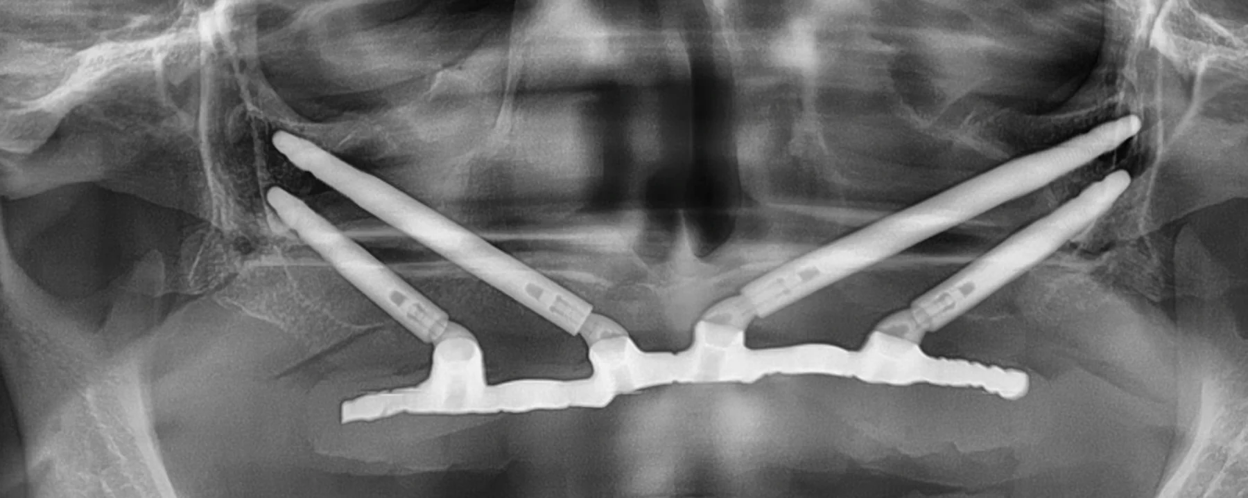 Radiografia panorâmica: quatro implantes zigomáticos unidos por uma barra