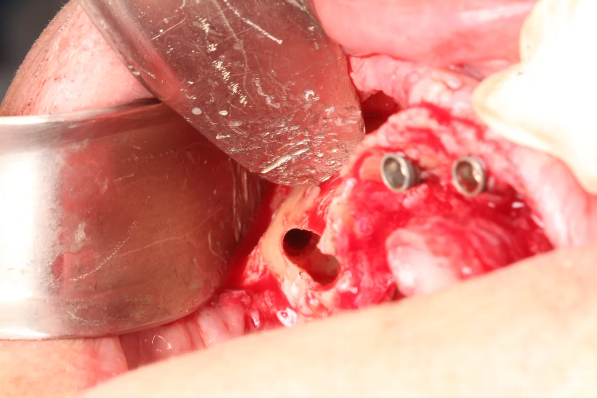 Foto cirúrgica: entrada da osteotomia zigomática ao lado de dois implantes anteriores