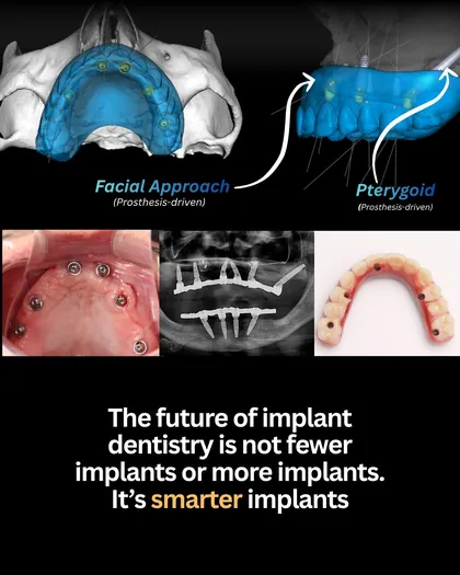 Post de 30 mar 2026: Durante anos, a discussão foi reduzida a uma pergunta simplista: mais implantes ou menos implantes?