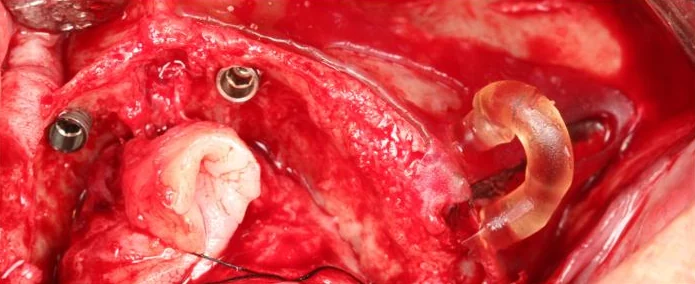 Foto cirúrgica: guia SkinGuide Zygoma assentado sobre o osso