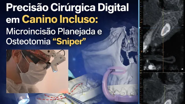Capa do vídeo: Precisão cirúrgica digital em canino incluso